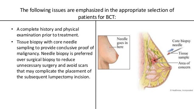 breast conservation therapy Pics big tits